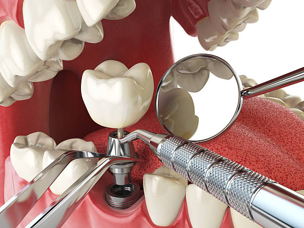 Best Lost Filling or Crown Replacement in Bedford, OH